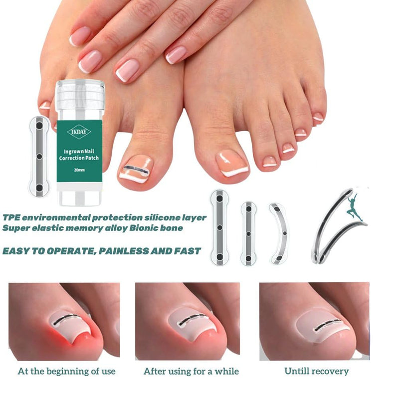 Ingrown Toenail Removal Kit | Titanium Alloy Ingrown Toenail Treatment | Pedicure Tools for Feet, Nail Tools Specially Designed for Curved Nail Repair and Ingrown Toenail Corrector (0.67/0.79in) 0.67/0.79in