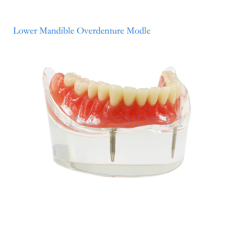 Dental Implant Model, Lower Jaw Overdenture, Removable Overdenture, with 2 Implants,M6002 M602