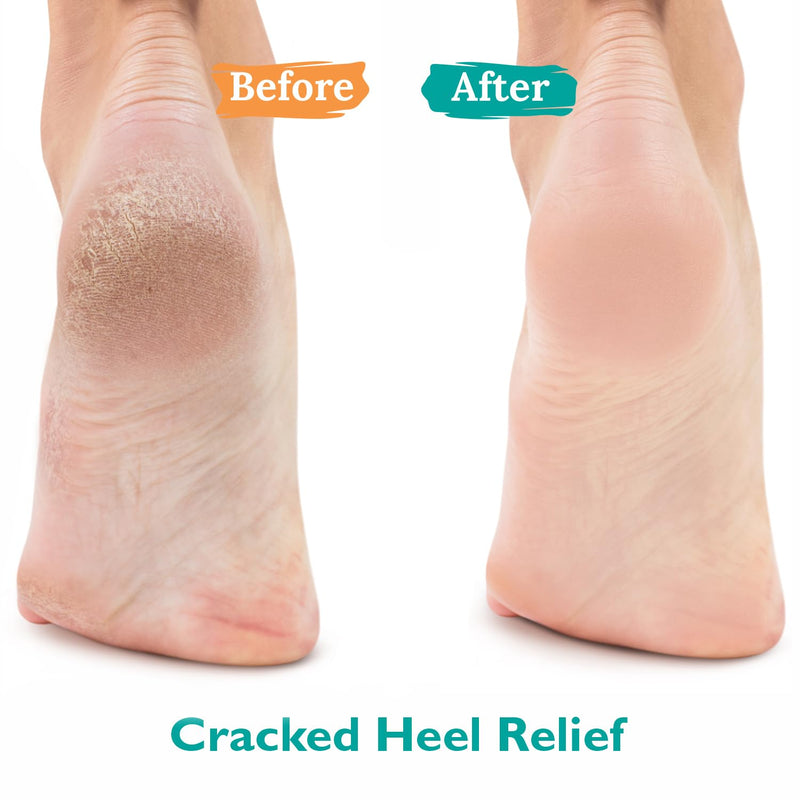 GILDEN TREE Urea Gel 42 Percent For Feet Maximum Strength Softens Cracked Heel Calluses & Thick Toenails 42% Urea Gel - BeesActive Australia