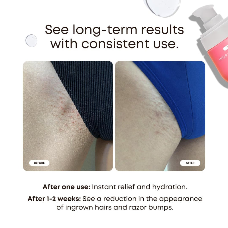 Bushbalm Ingrown Hair Oil - Helps Prevent and Repair Skin from Ingrown Hairs, Razor Burn & Underarm Bumps - Soothe Skin from Post Shave Itchiness, Irritation and Redness, 30 ml - Watermelon Sugar Oil - BeesActive Australia