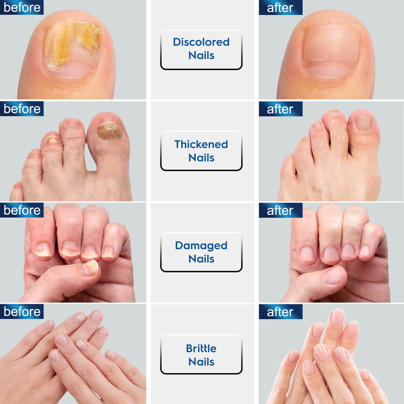 Advanced Toenail Fungus Treatment – Helps Reduce Thick, Yellow Nails & Maintain Healthier Toenails Over Time, Toe Nail Fungus Treatment Extra Strength 2pcs x15ml. Unsented - BeesActive Australia