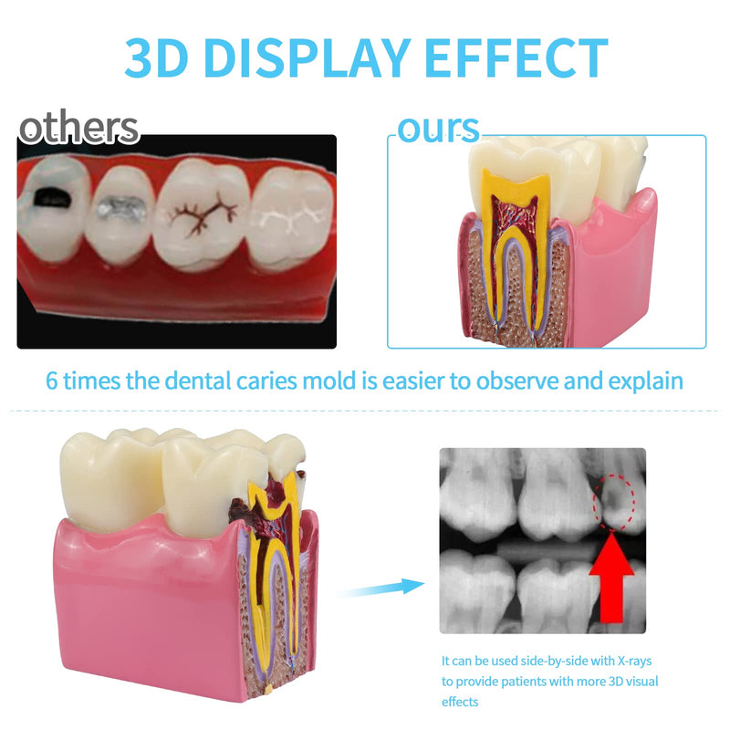 ANNWAH Dental Caries Teeth Model,Dental Anatomy Education Tooth Model,6 Times Caries Teaching Typodont Tool for Dentists, Patients, Teachers and Students - BeesActive Australia
