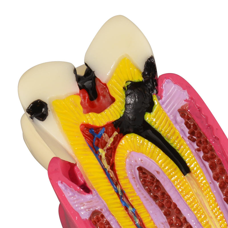 Ultrassist Dental Tooth Decay Model, Dental Caries Demonstration Model, Tooth Anatomy Teaching Model for Dental Education, Patient Explanation and Oral Health Classroom Teaching - BeesActive Australia