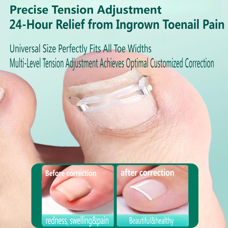Ingrown Toenail Corrector Kit for Men Women - Ingrown Nail Tool - 2 Stainless Steel Clips- Curved Nail Strips & Toe Pads for Embedded/Curled Nails