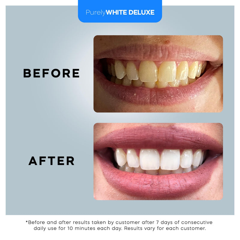 PurelyWHITE DELUXE Teeth Whitening Kit, Complete LED Teeth Whitening, 15+ Treatments, (3) 3ml Whitening Gel Syringes, Whiter Smile in 7 Minutes - BeesActive Australia