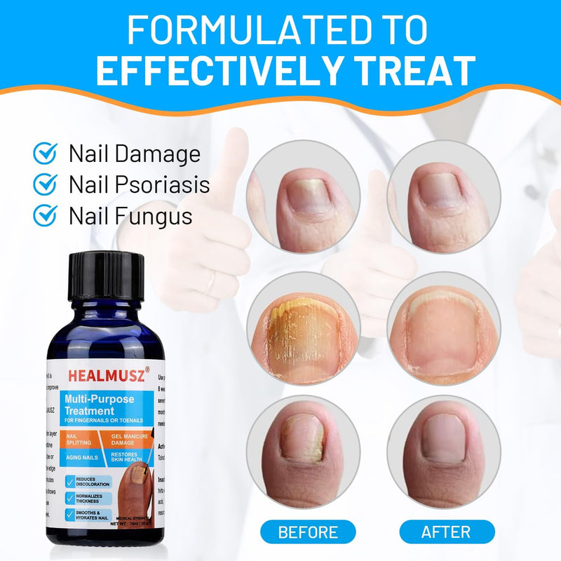 Toenail Fungus Treatment Extra Strength – Fast Acting Repair for Healthy Nails.