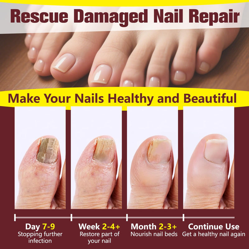 Toenail Fungus Treatment Extra Strength, Nail Fungus Treatment for Yellow, Thick, Discolored, Broken Nails, Ultimate Fungal Nail Repair, Make Nails Look Healthier Stronger, 2 Bottles 1 Count (Pack of 2)