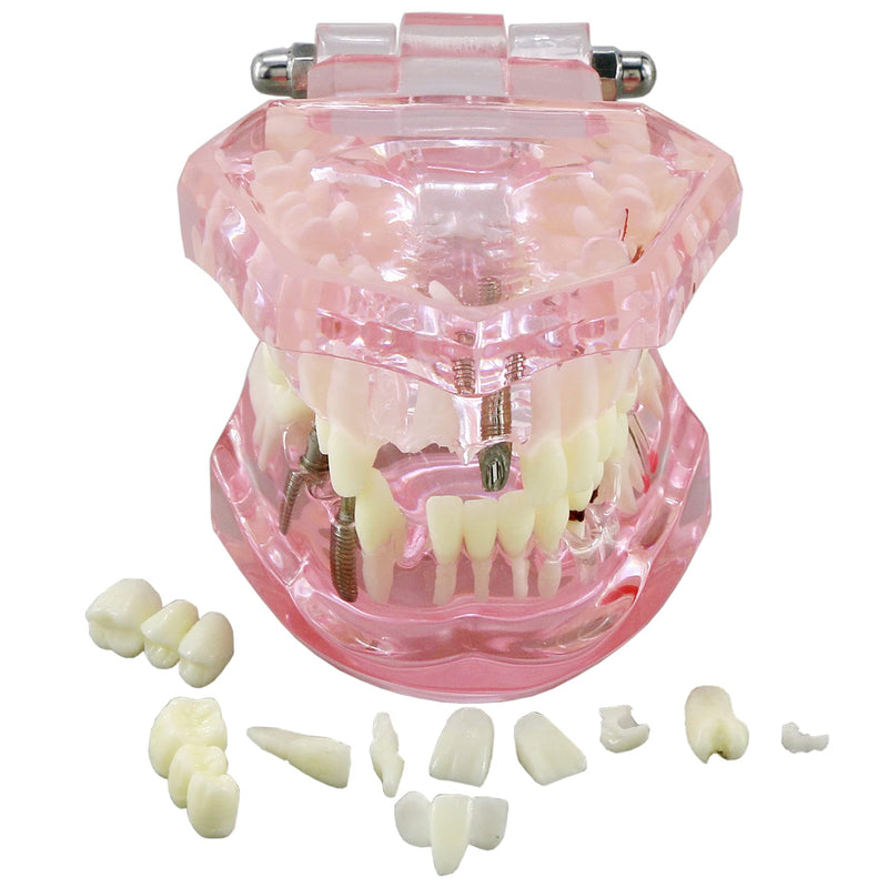 Teeth Model Teeth Typodonts Dental Implant Study Analysis Demonstration Teeth Model #2001 with Restoration Pink - BeesActive Australia