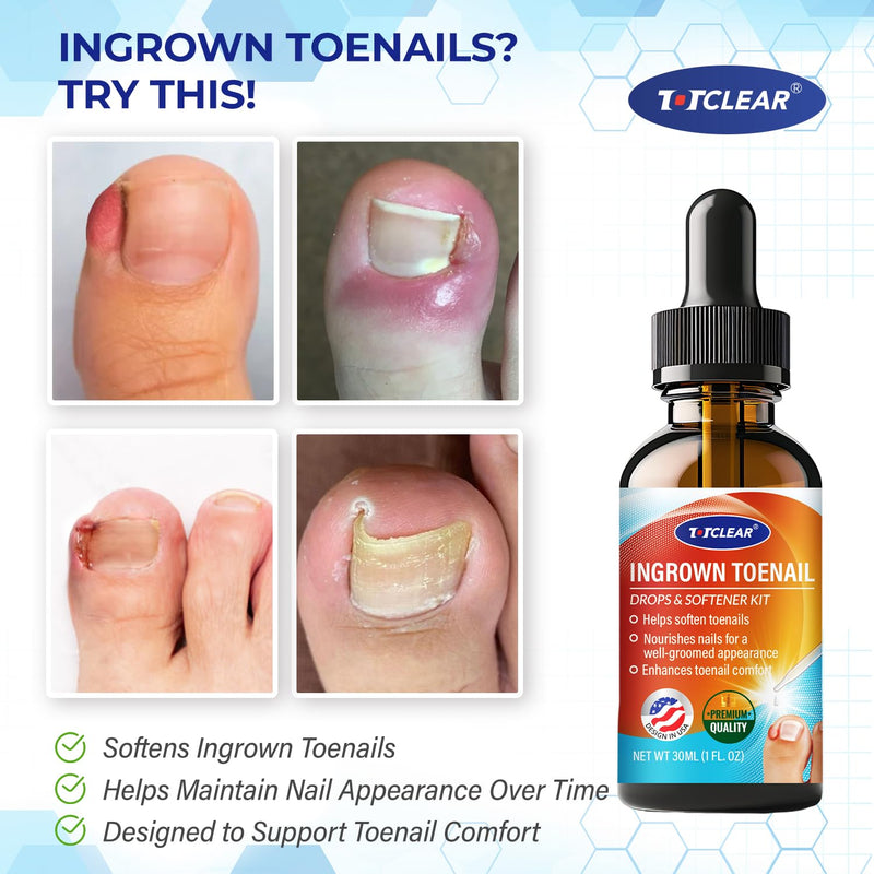 Ingrown Toenail Relief: Ingrown Toenail Tool for Men Women - Ingrown Toenail Removal Kit - Ingrown Toenail Corrector Drops - Ingrown Toenail Removal - Effective Solution for Ingrown Toenails - 30ml 1 Fl Oz (Pack of 1)
