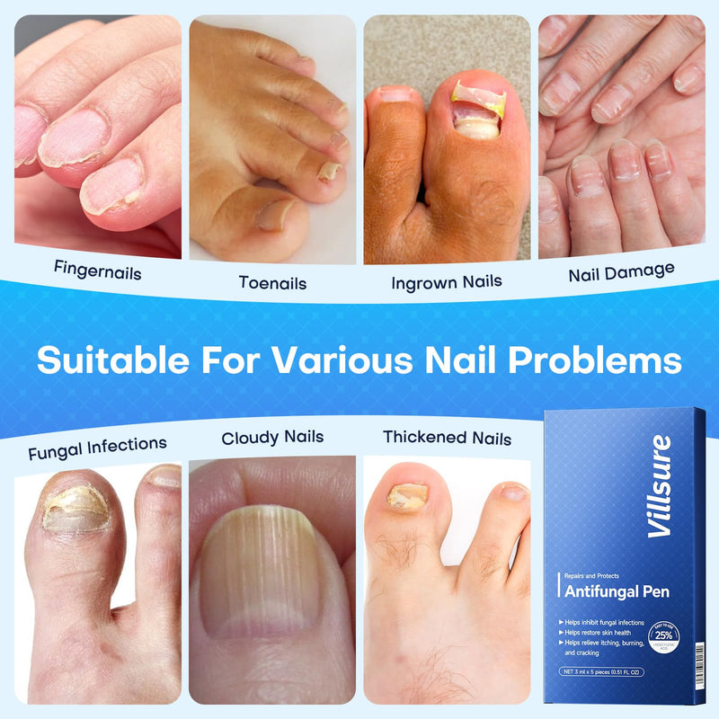 Villsure Toenail Fungus Pen - Toenail Fungus Treatment Extra Strength, Contains 25% Undecenoic Acid, Tea Tree Oils, along with Other Natural Ingredients, Mild and Non-Irritating- Nail Fungus Pen 5pcs - BeesActive Australia