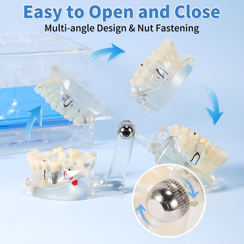 Annhua Transparent Disease Teeth Model for Dental Students, 32 Standard Removable Typodont Teeth Pathological Teaching Model - Ideal for Teaching, Not for Clinical Use Standard-Transparent Teeth Model - BeesActive Australia