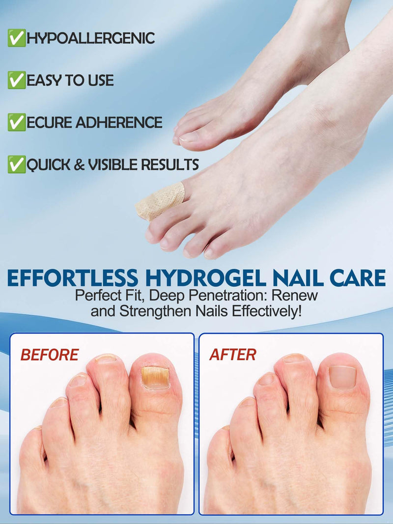 Nail Patches Toenail Treatment Extra Strength 8-Hour Overnight Nail Fast Acting Repair Effortless Hydrogel Nail Care and Repair for Damaged Nails Overnight Renewal for Men and Women (24, Medium)