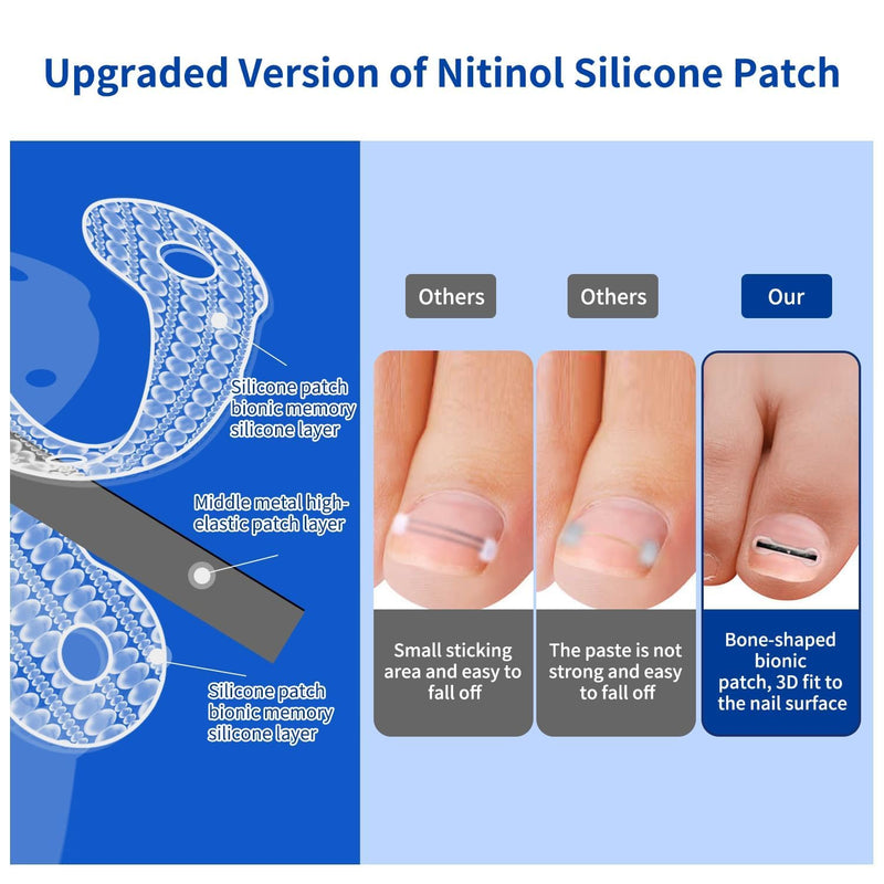 Ingrown Toenail Treatment, 10 packs Titanium Alloy Ingrown Toenail Corrector for all size foot, Ingrown Toenail Removal Kit for Curved Nail Repair, at Home Nail Kit Tools-Blue03