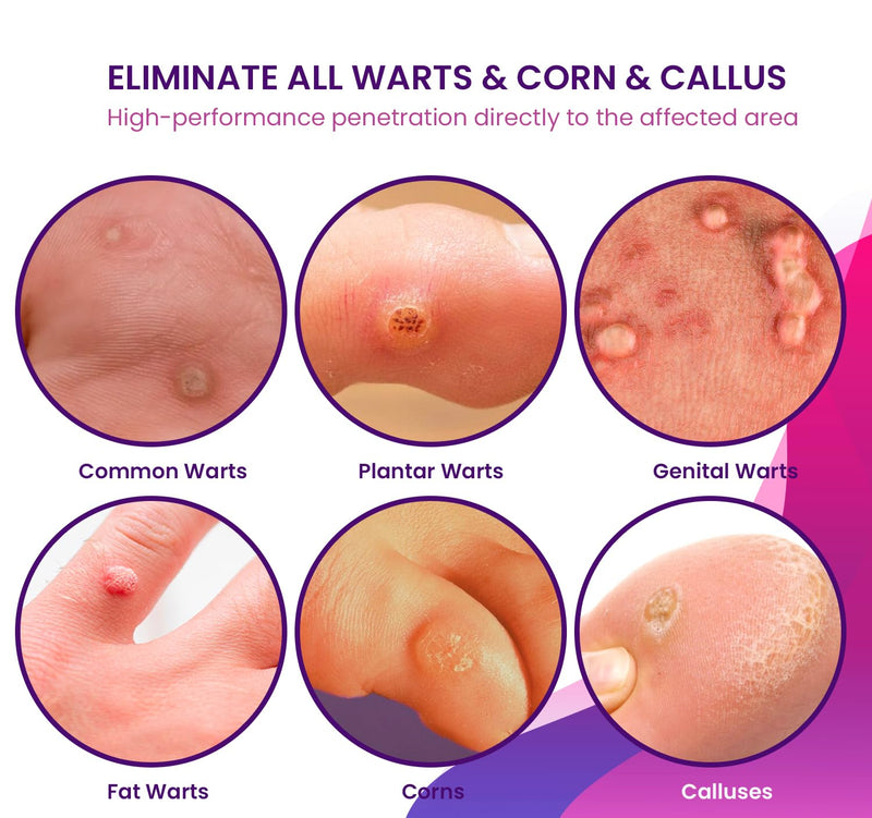 Maximum Strength Fast Acting Wart Cream - Wart Cream with Salicylic Acid - Fast-Acting Wart Ointment, Wart Cream for Warts, Plantar Wart, Genital Warts, Common Wart, Corn - Wart Remover Freeze Off - BeesActive Australia
