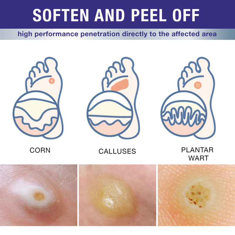 DrLuke Wart Corn Remover for Toes Feet: Fast Acting Plantar Wart Common Wart Flat Wart Corn Removal - Salicylic Acid Wart Corn Removal for Feet Toes Finger and Hand - BeesActive Australia