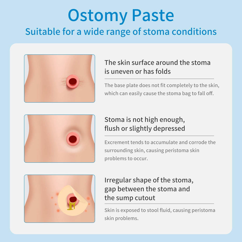 Stoma Skin Barrier Ostomy Paste - Protective Ostomy Skin Barrier Supplies - Stoma Adhesive Skin Protectant Paste - Ostomy Skin Barrier Paste, 2 oz - BeesActive Australia