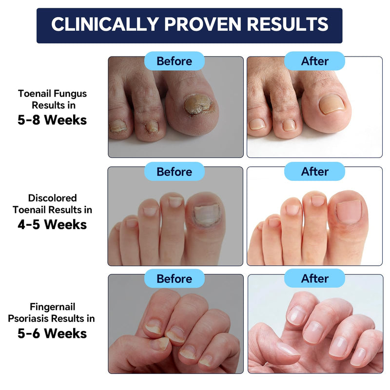 Toenail Fungus Treatment Extra Strength - with 25% Undecylenic Acid - Effective Nail Repair for Damaged Nails, Ingrown Nails & Discoloration - 4-Pack Twist Pen