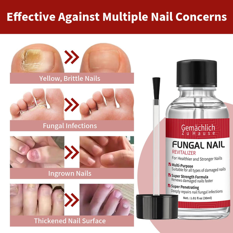Toenail Fungus Treatment Extra Strength, Nail Fungus Treatment with Undecylenic Acid for Toenail & Fingernails, Antifungal Nail Repair for Athletes Foot, Ingrown, Thick, Broken, Damaged Nail, 30ml 1 Fl Oz (Pack of 1)