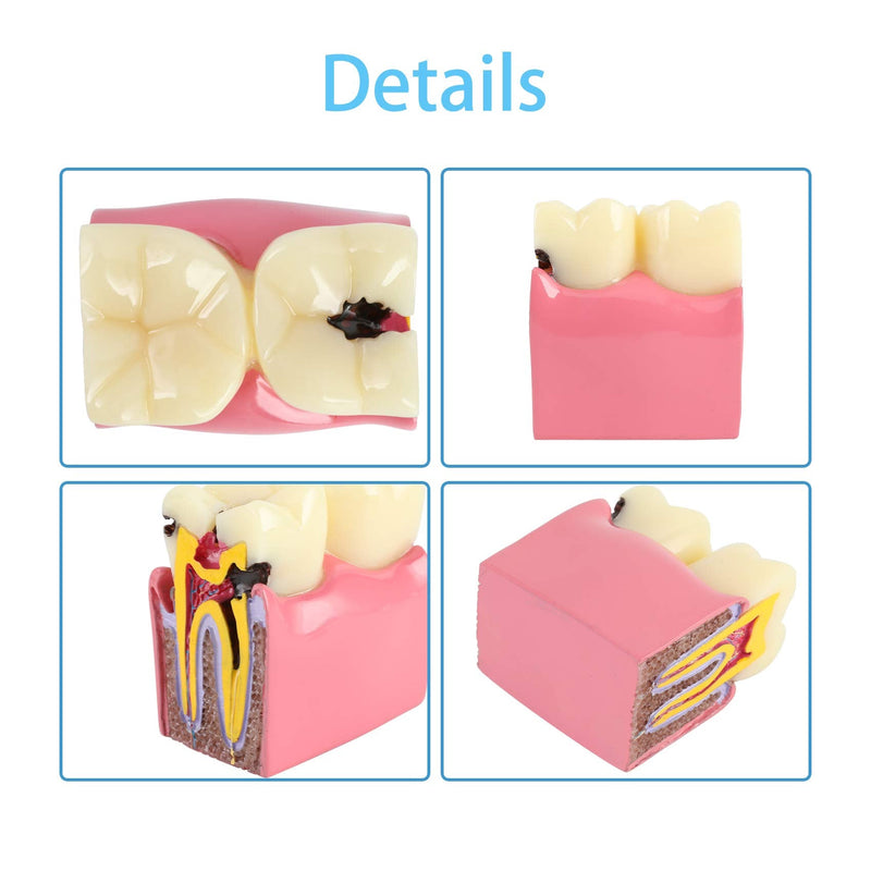 Dental Caries Tooth Model 6 Times Decay Teeth Comparative Study Model, Caries Bilateral Comparison Pathology Teeth Model Teaching Learning Tools for Dentist, Patient Education and Explanation - BeesActive Australia