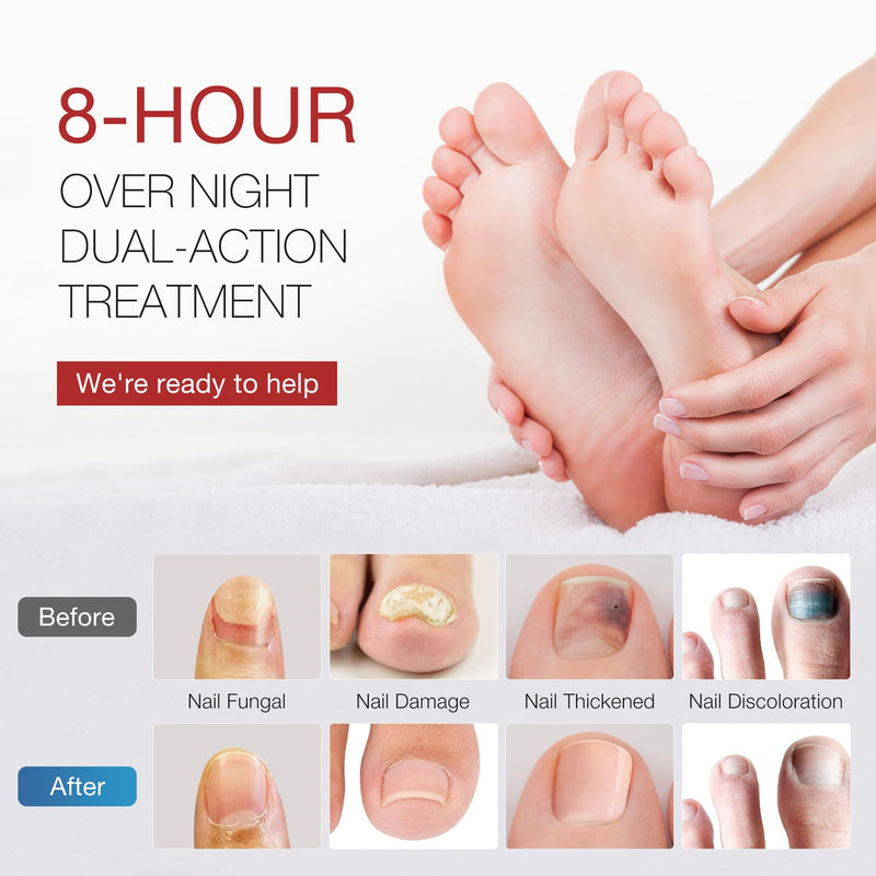 Toenail Fungus Treatment Extra Strength - Toenail Fungus Treatment Pen & Fungal Nail Patches, Day and Night Fungal Nail Treatment Set Ideal for Nail Repair for Damaged Nails Toenail Fungus - BeesActive Australia