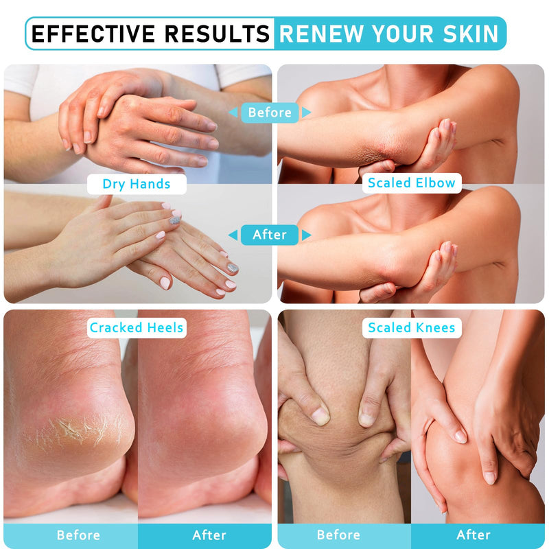 Urea Cream 40 Percent for Feet Maximum Strength w/ Vitamin E & 2% Salicylic Acid, Non-Greasy Formula Foot Cream for Summer Dry Cracked Heels - Intense Moisturizer Callus Remover for Hands, Foot, Body Camellia-Mild 5.3 Ounce (Pack of 1)