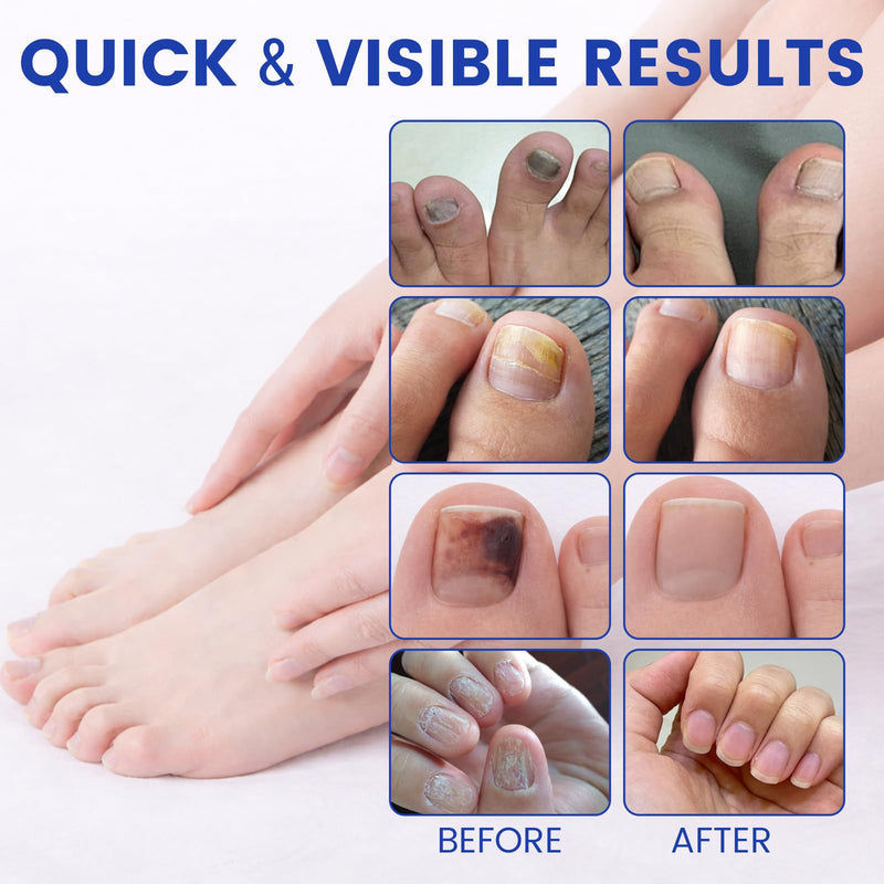 Toenail Fungus Treatment Extra Strength - 42 Pcs Fungal Nail Patches, 8-Hour Firm Adhesion, Nail Repair for Damaged Nails, Overnight Renewal for Men & Women (2 Count (Pack of 21)) 0.88 Ounce (Pack of 2) - BeesActive Australia