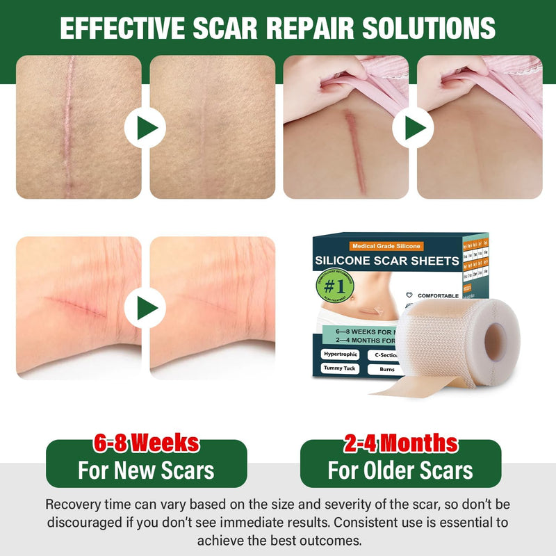 Silicone Scar Sheets, Silicone Scar Tape, Silicone Sheets For Scars, Scar Tape For Surgical Scars, Scar Removal For Surgical(1.6"x 60" Roll-1.5M) 1.5M