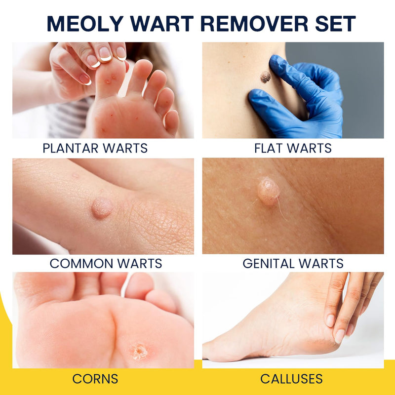 Plantar Wart Remover Set: Maximum Strength Salicylic Acid Plantar Wart Remover 12 Thick Cushioning Pads 1.5