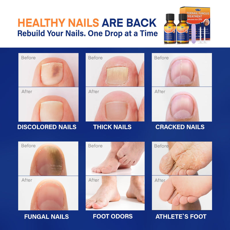 Toenail Fungus Treatment with 25% Undecylenic Acid: Toenail Fungus Treatment Extra Strength for Thick, Yellow and Damaged Nails - Safe and Gentle for Nails Care - BeesActive Australia