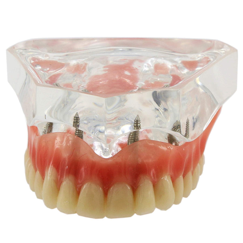 Dental Upper Implants Model Overdenture with 4 Superior Teeth Demo Transparent Vision for Education and Study Model Tool M6001 C