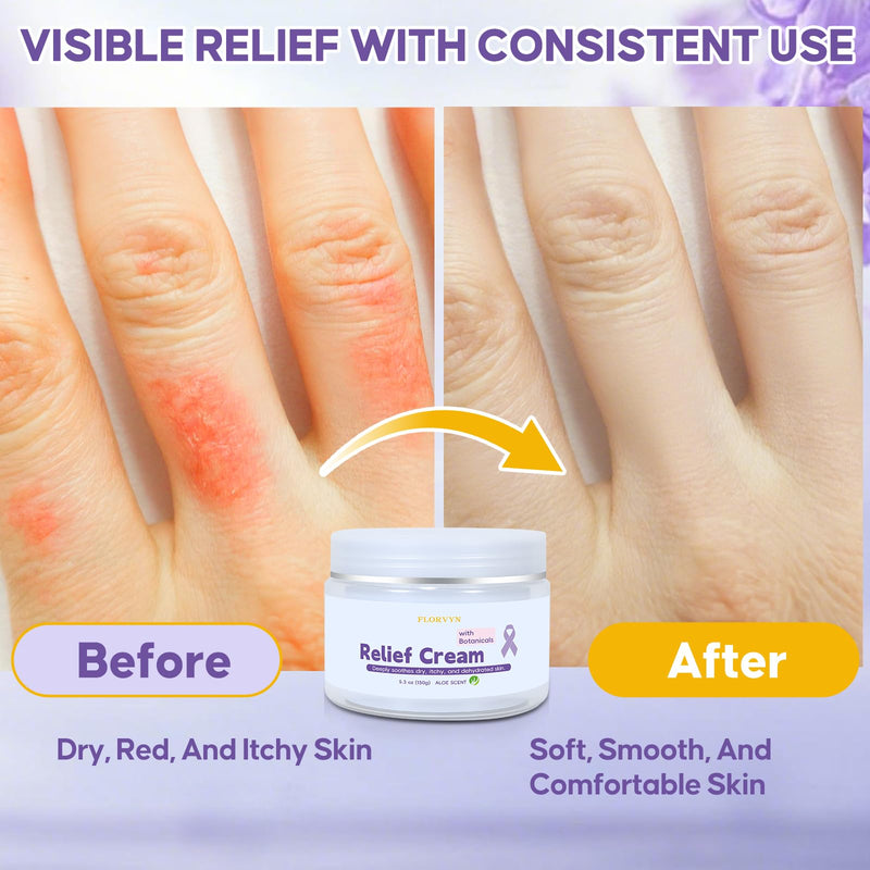 Radiation Burn Relief Cream, Soothing Moisture Cream for Sensitive Patients, Dry & Irritated Skin, Nourishing Hydration, Gentle Daily Skincare Cream for Calming Redness & Discomfort, Aloe Vera Scent