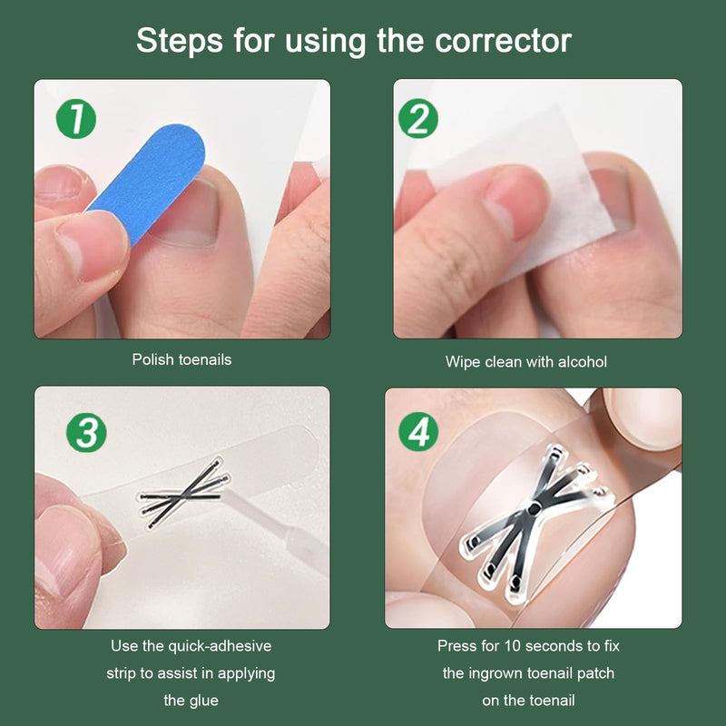 Titanium Alloy Ingrown Toenail Treatment 3X Stronger Pulling Force, Nail Tools and Ingrown Toenail Repair Kit for Curved & Thick Nails, Professional Foot Care Solution for Men & Women (0.63/0.67 in) 0.63-0.67in - BeesActive Australia