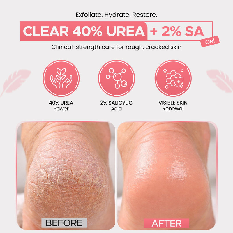 CLEAR Urea Cream 40 Percent Plus 2% Salicylic Acid (4oz) Made in USA | Urea Foot & Hand Cream Softens Cracked Heels & Dry Skin with Tea Tree & Coconut Oil - Callus & Corn Treatment 40% Urea & 2% Salicylic Acid | Tea Tree Oil & Coconut 4 Fl Oz (Pack of 1) - BeesActive Australia