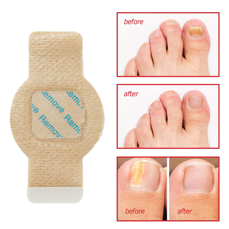 Nail Patches 21Pcs, Toenail Care Treatment Extra Strength, 8-Hour Overnight Hydrogel Nail Repair Patches for Damaged Nails, Improve Toenails Texture & Thickening 1 Count (Pack of 21) - BeesActive Australia
