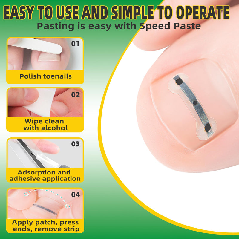 Ingrown Toenail Treatment Kit, Titanium Alloy Ingrown Toenail Removal Kit, Nails Corrector Tool & Remover Strips - Ingrown Toe Nail Quick Relief 10 Count (Pack of 1)