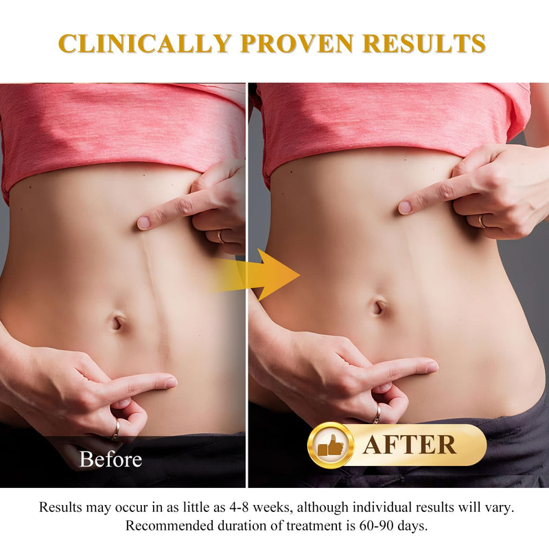Scar Cream Silicone Scar Gel, Scar Cream for Surgical Scars, Advanced Scar Removal Cream for C-Section, Injury, Acne, Burns, Keloids, Stretch Marks, Old & New Scars, 1.85 Oz (55g) 1.85 Fl Oz - BeesActive Australia