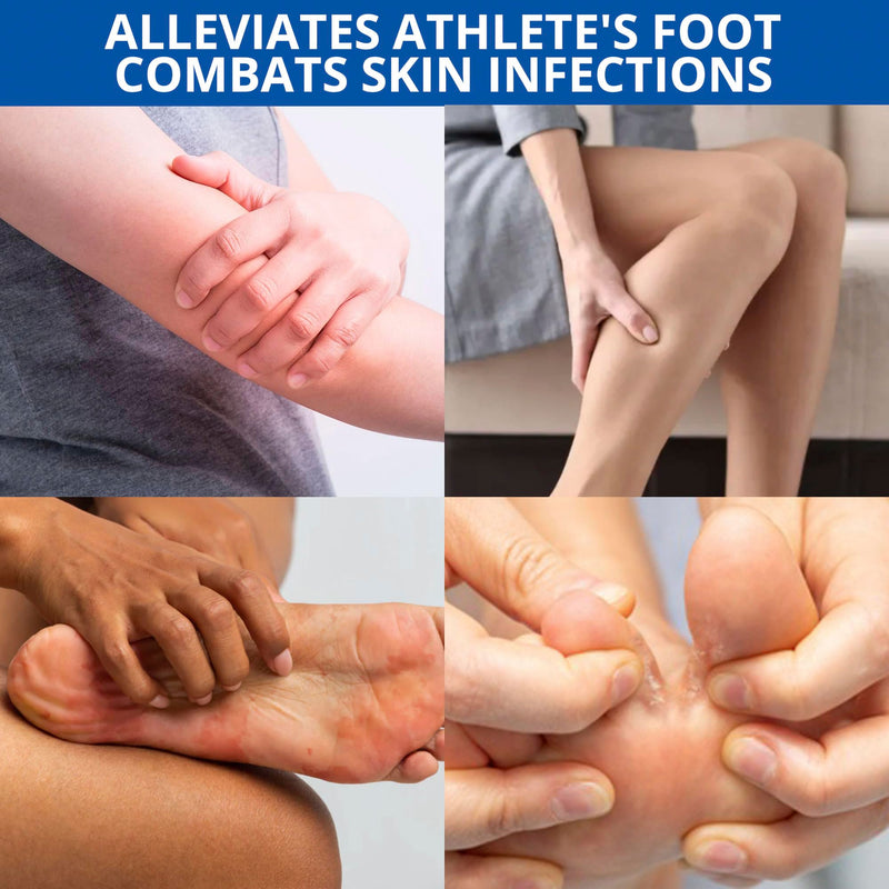 Athletes Foot Treatment-Antifungal Cream-Treatment for Jock Itch,Ringworm, Psoriasis,Eczema,Rash-Anti Fungal Skin Cream for Itchy Skin-Foot Balm with Natural Ingredients-50g 1.7 Fl Oz (Pack of 1)