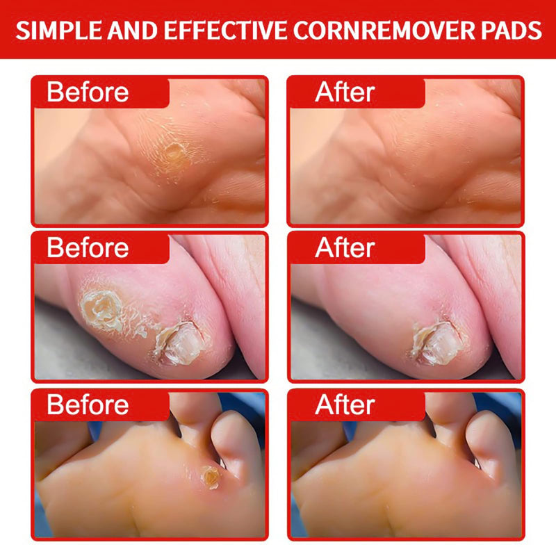 Corn and Callus Remover for Toes and Feet - Extra Strength 40% Salicylic Acid Nursing Pads-Formulated With a Safe Formula to Effectively Remove Corns and Calluses（42 Pack） - BeesActive Australia