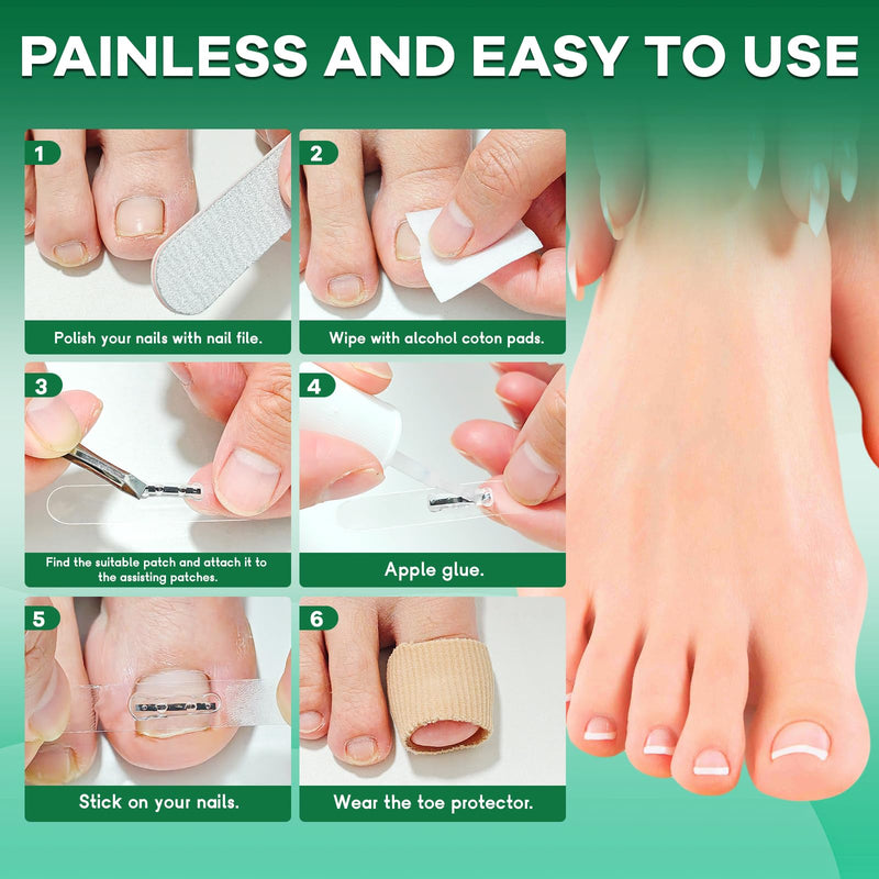 Titanium Alloy Ingrown Toenail Corrector New Version Ingrown Toenail Removal Tool Kit, Designed for Curved Nail Repair Big Toe Ingrown Toenail - BeesActive Australia