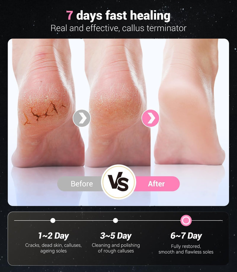 5-in-1 Professional Electric Callus Remover for Feet(Portable & Foldable), Removes 99.92% of Calluses in 3 Mins, Eectric Foot Callus Remover Pedicure Kits with 10 & 40 Grit Pads for Smooth Feet, Pink 01-pink - BeesActive Australia