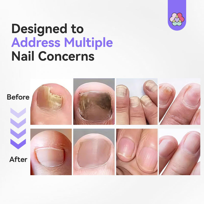 SAVILAND Toenail Fungus Pen Extra Strength: 2X Extreme Nail Repair 25% Undecylenic Acid 1% Tolnaftate Nail Fungus Pen for Damaged Yellow Discolored Thick Foot Toe Nails Softener Treatment Solution - BeesActive Australia