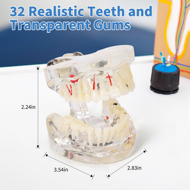 Annhua Transparent Disease Teeth Model for Dental Students, 32 Standard Removable Typodont Teeth Pathological Teaching Model - Ideal for Teaching, Not for Clinical Use Standard-Transparent Teeth Model - BeesActive Australia