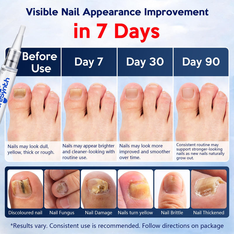 Extra Strength Nail Fungus Repair Pen (OTC Maximum Strength), 25% Undecylenic Acid + Aloe & Vitamin E, For Thick Yellow Discolored Nails, 24 mL (0.81 fl oz) Total, 8-Pack,Designed in USA (White) White