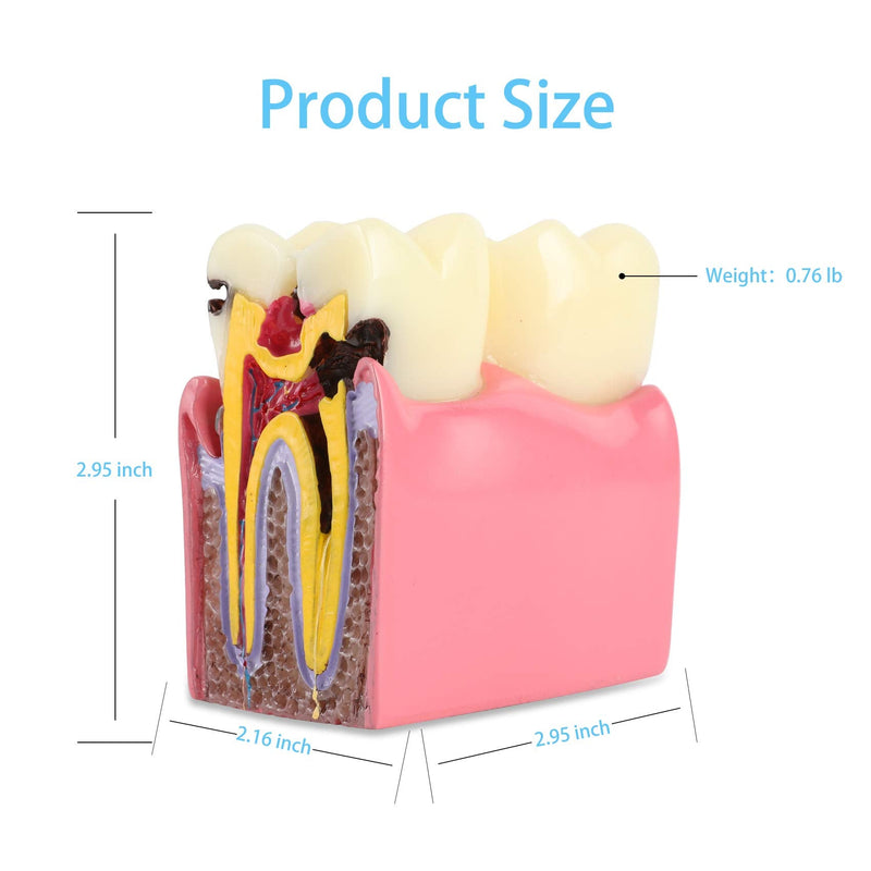 Dental Caries Tooth Model 6 Times Decay Teeth Comparative Study Model, Caries Bilateral Comparison Pathology Teeth Model Teaching Learning Tools for Dentist, Patient Education and Explanation - BeesActive Australia