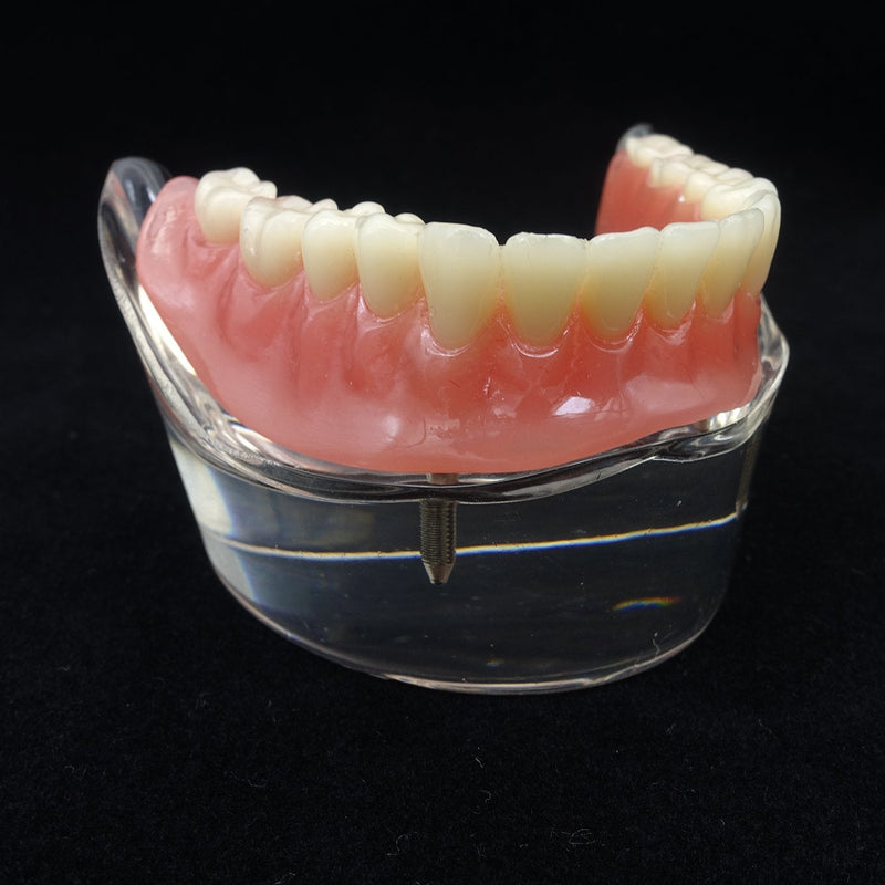 Dental Model Overdenture Inferior 2 Implants Demo for Studing and Teaching