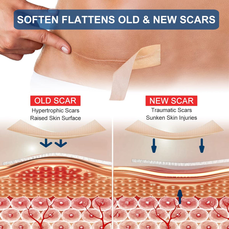 Silicone Scar Sheets Tape for Surgical Scars, C Section Scar Silicone Strips, Medical Grade, Reusable, Soften and Flattens Scars, Breast, Keloid, Professional Scar Patches. (1.8x157 Inch) 1.8x157 Inch