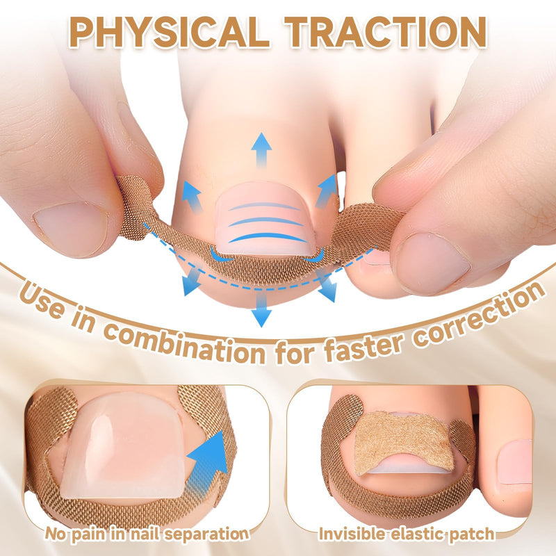201 Pcs Ingrown Toenail Corrector Kit with Breathable Correction Strips, Curved Nail Patches, Toenail Lifter Tools, Complete Home Pedicure Set for Daily Nail Grooming & Nail Shaping