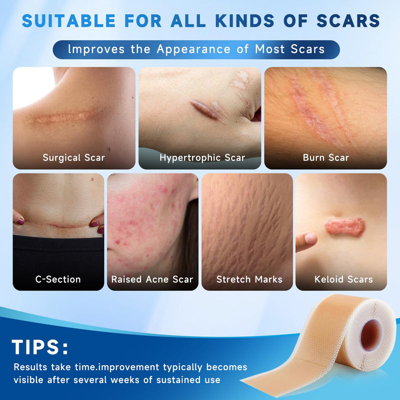 Silicone Scar Sheets, Silicone Scar Tape(1.8‚Äù x 157‚Äù Roll 4M), Silicone Scar Sheets for Surgical Scars, Keloid Bump Removal, Stretch Marks Removal, C-Section, Burn et Brown