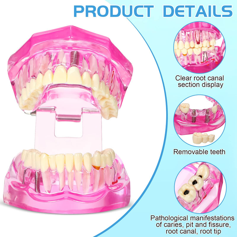 Outus Disease Teeth Model Dental Implant Teeth Model with Removable Tooth Dentist Standard Tooth Pathological Demonstration for Christmas Education Dental Supplies(Pink,1 Pcs) 1 Pink - BeesActive Australia