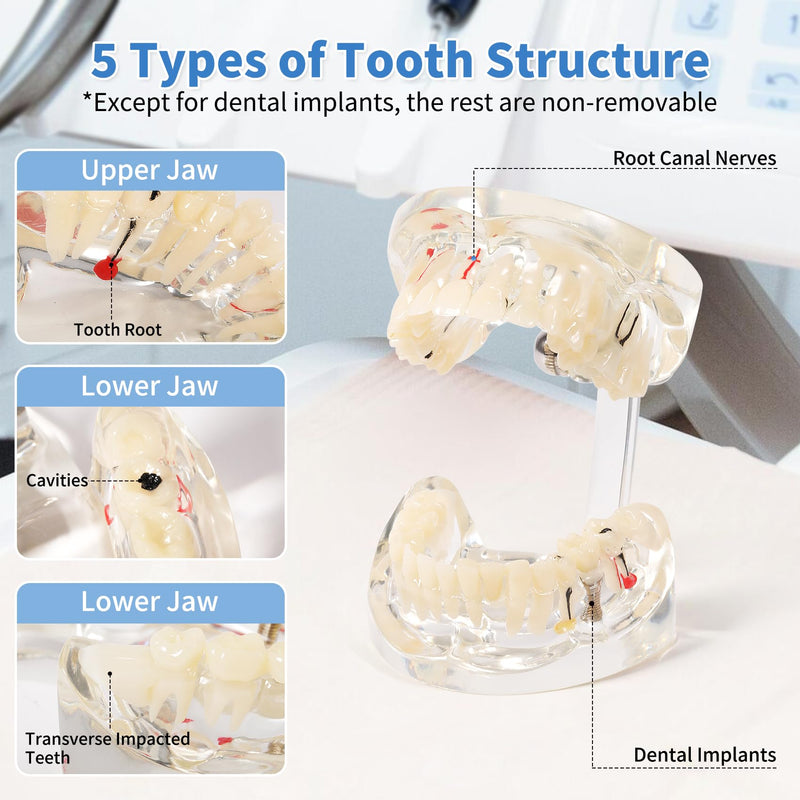 Annhua Transparent Disease Teeth Model for Dental Students, 32 Standard Removable Typodont Teeth Pathological Teaching Model - Ideal for Teaching, Not for Clinical Use Standard-Transparent Teeth Model - BeesActive Australia